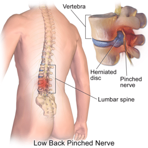 Bulging disc, low back pain